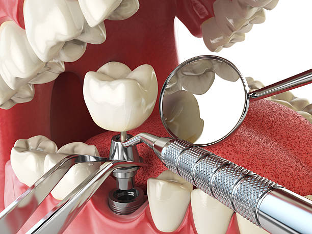 Best Emergency Dentist for Lost Fillings or Crowns in Laurel, MT